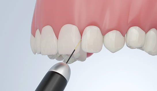 Illustration of gums being treated with soft tissue laser