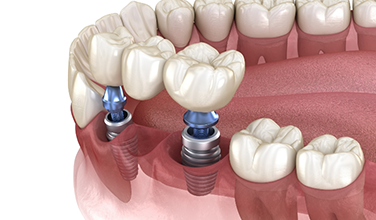 Dental bridge being attached to a pair of dental implants