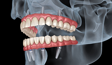 Illustration of dentures attached to dental implants in upper and lower jaw