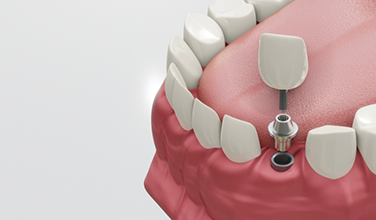 Crown and abutment being attached to dental implant in lower arch