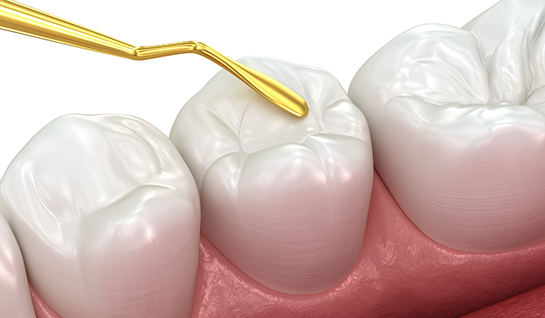 Dental sealants being applied to lower teeth