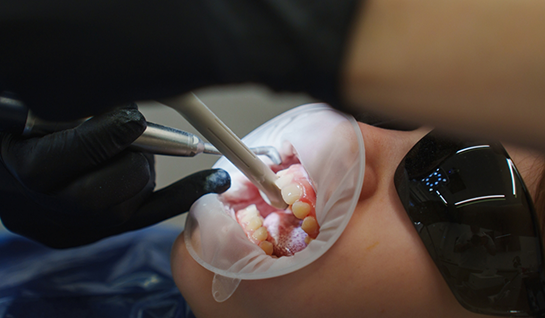 Patient with lip guard receiving fluoride treatment