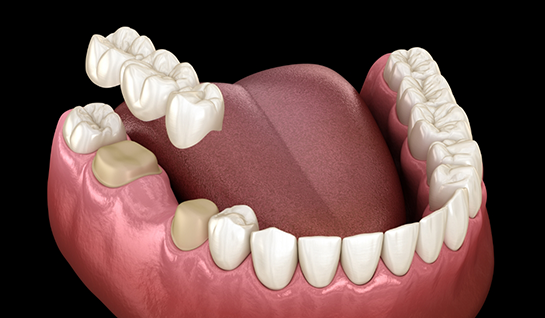 Illustration of dental bridge being attached to lower teeth