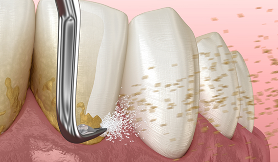 Illustration of scaling and root planing for lower teeth