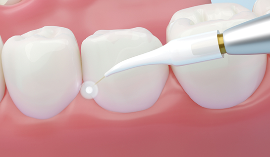 Illustration of gums being treated by soft tissue laser