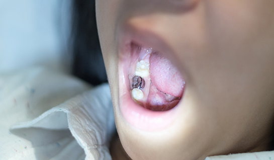 Opening mouth to show decayed tooth