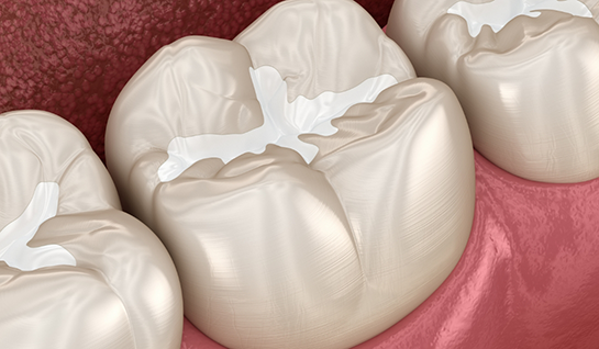 Illustration of teeth with dental sealants