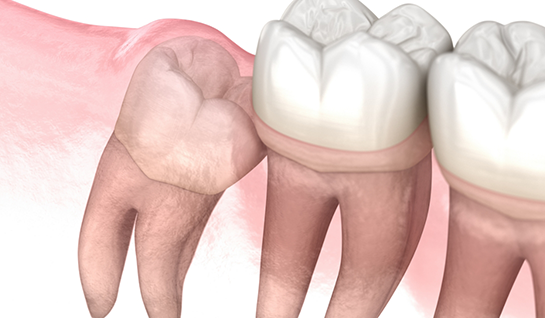 Illustration of impacted wisdom tooth